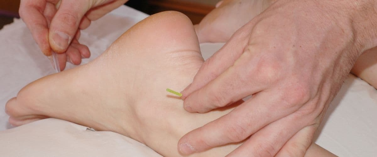 Acupuncture Massage Plantar Fasciitis
