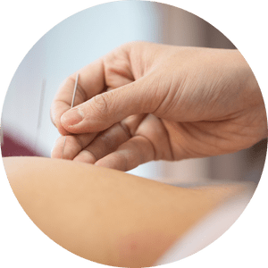 Acupuncture Newport