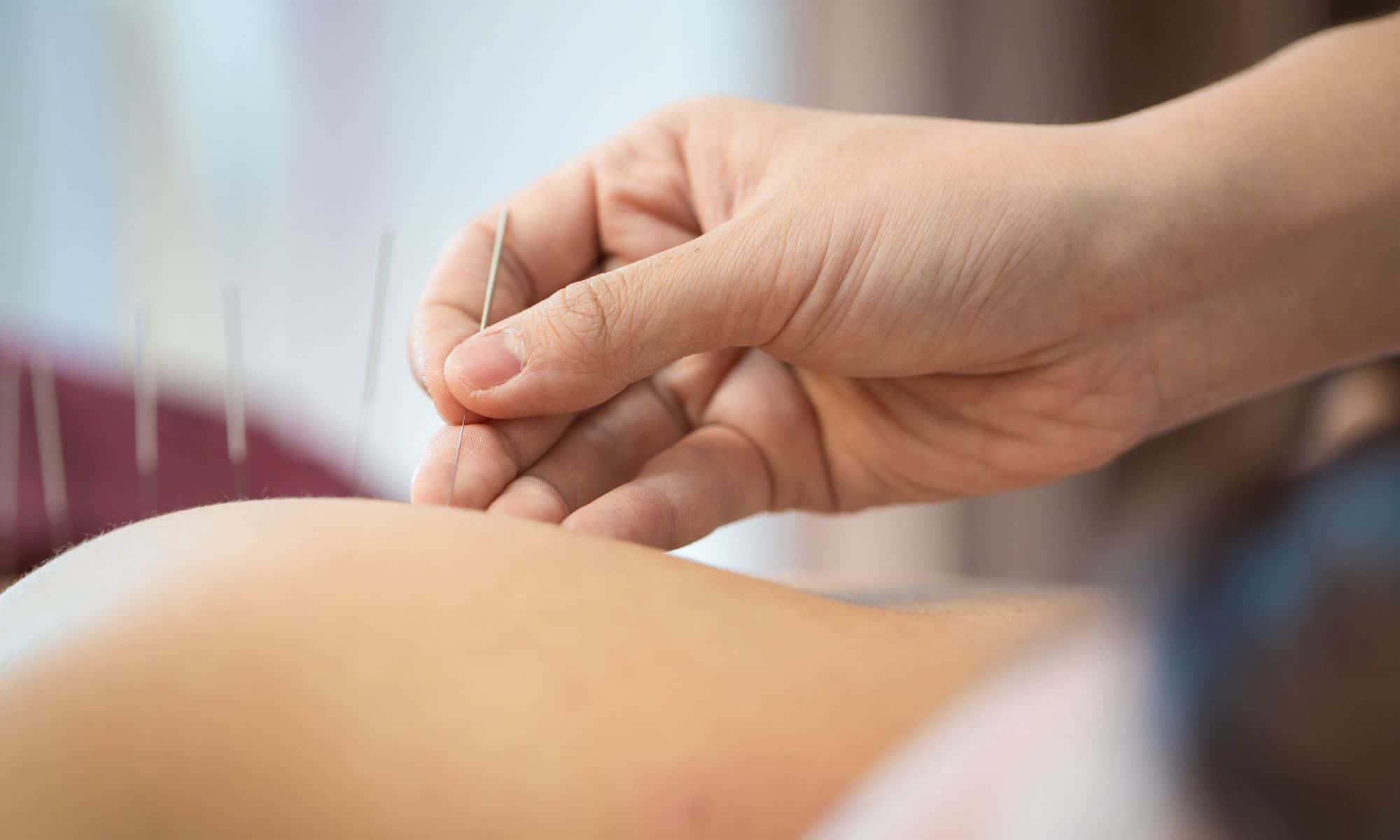 acupuncture Mona Vale