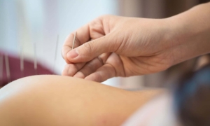 acupuncture image