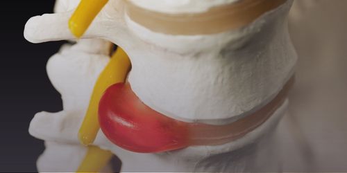 disc injury